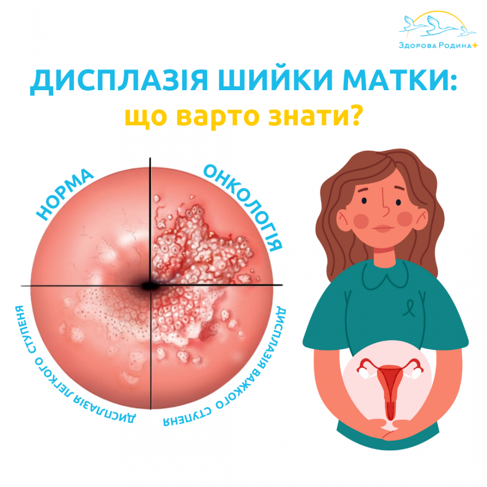Дисплазія шийки матки: що варто знати