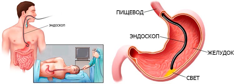 Биопсия желудка